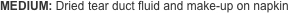 MEDIUM: Dried tear duct fluid